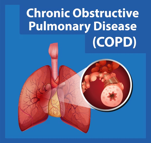 Chronic Obstructive Pulmonary Disease (COPD)