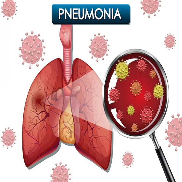 Pneumonia