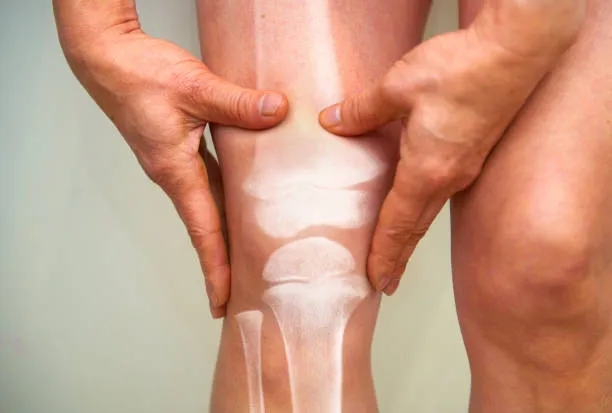 Osteoarthritis